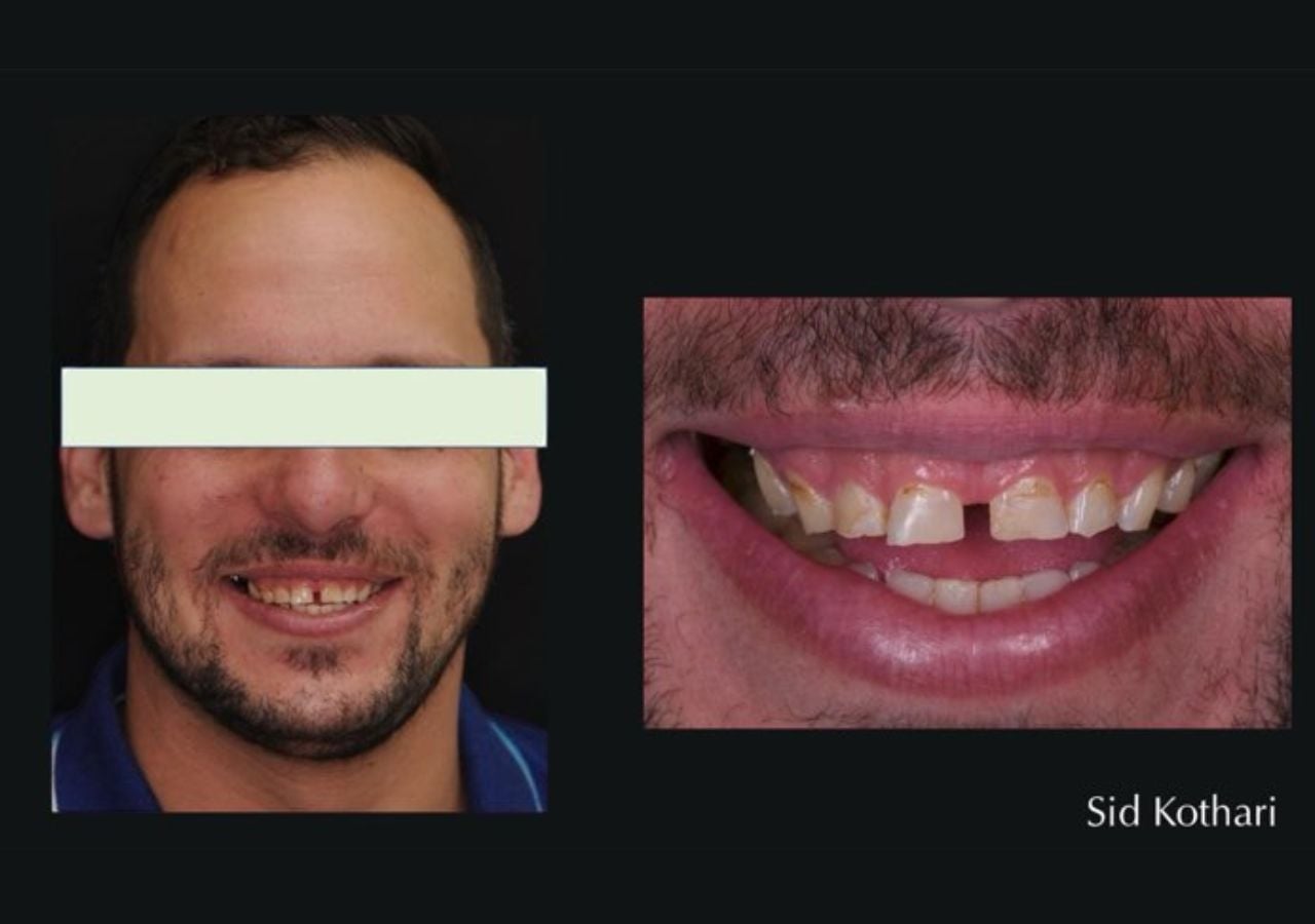 Before Treatment